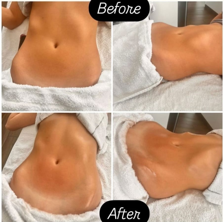 Lymphatic drainage — before and after